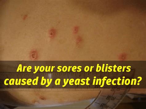 yeast infection sores and blisters what do yeast infection