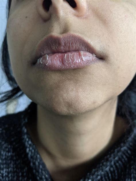 stop picking  lips  stopped   days