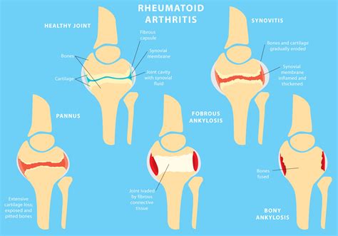 joint rheumatoid arthritis   vector art stock graphics images