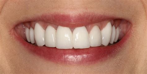 gum surgery dental crowns smile makeover