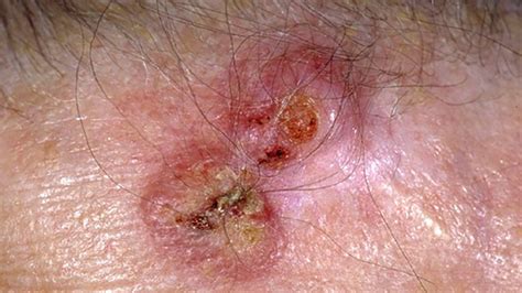 En Réalité Téméraire Domaine Skin Cancer Spots Images Ouvreur Farine Paix