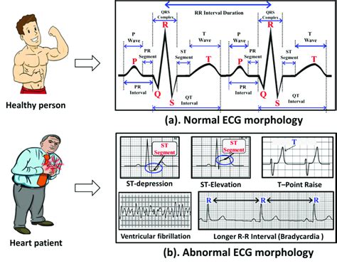 normal  abnormal ecg morphologies  scientific