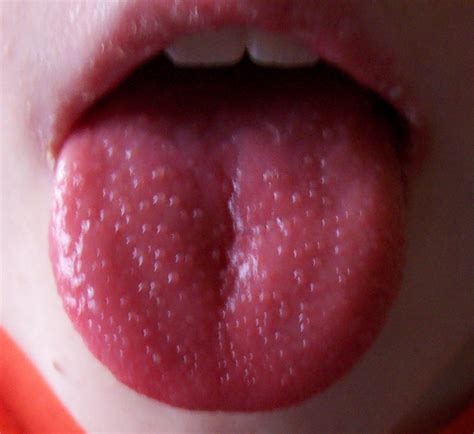 review of tongue lesions quiz d e r m l i v e