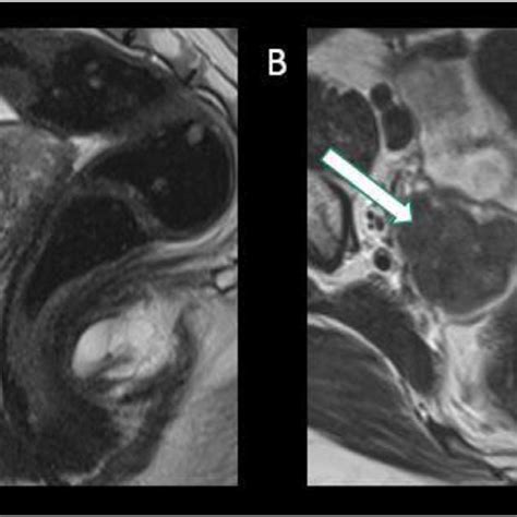 a sagittal t2 weighted image showing anteverted uterus with normal