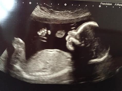 Skull Theory 20 Week Scan Picture In Ultrasound Gender Prediction Forum