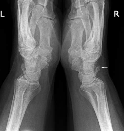 triquetral fractures wikiradiography
