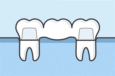 good care   dental bridge       teeth