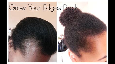 regrow hairline fast boost  natural  edges  works