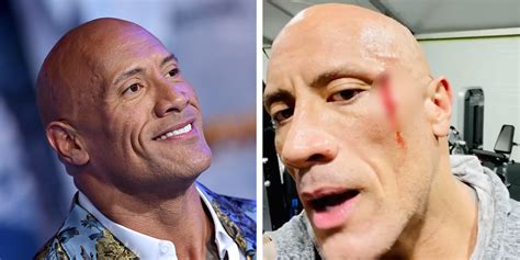 Dwayne ‘the Rock’ Johnson Had A Gnarly Gym Accident—here S What