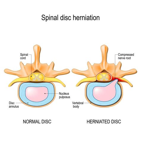 surgical treatments  herniated discs texas spine clinic