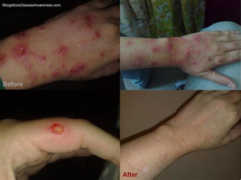 Morgellons Disease Awareness Morgellons Disease Tips For Healing