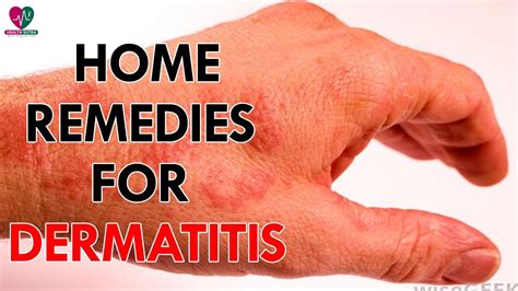 home remedies  dermatitis health sutra youtube