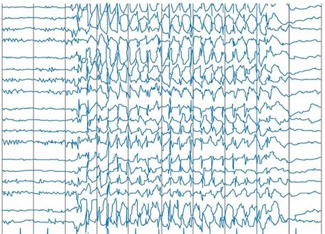 epilepsie koortsconvulsies en het risico op adhd extra praktische pediatrie