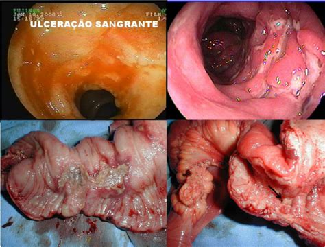 endoscopic appearance of crohn s disease cd a bleeding ulcerated