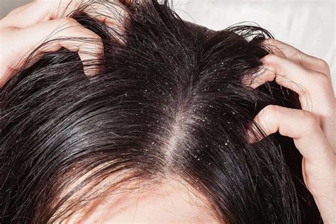 causing  scalp irritation modena hair