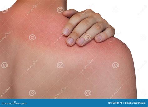 man  reddened itchy skin  sunburn  white isolated background stock photo image