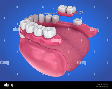 removable partial denture medically accurate  illustration stock photo alamy