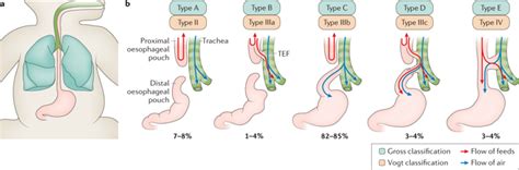Oesophageal Atresia Nature Reviews Disease Primers X Mol