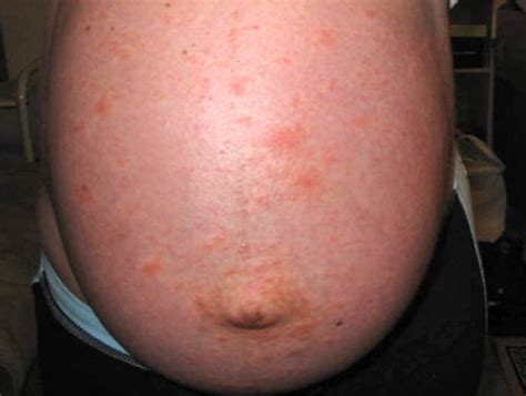 skin rash pregnant most expensive dildo