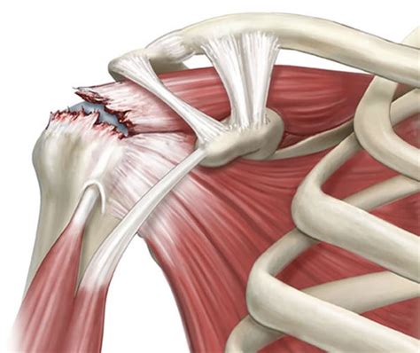 rotator cuff repair surgical rehab specialists