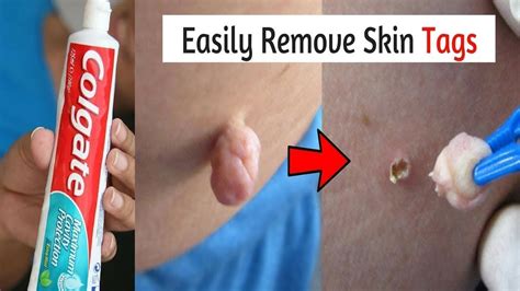 how to remove skin tags naturally overnight with garlic best skin