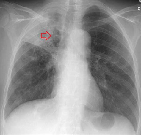 cureus pulmonary tuberculosis  gastric bypass   rare