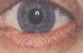 eyelash demodex mites