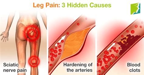 Leg Pain 3 Hidden Causes Menopause Now