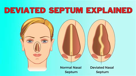 What Causes A Deviated Nasal Septum Doctor Steven Y Park Md New