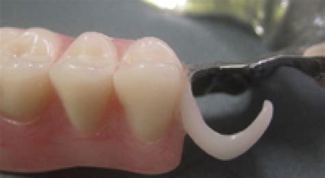 tooth coloured flexible clasps dentacast