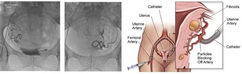 Vascular Intervention Arterial University Hospitals Coventry