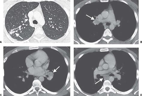 Upper Lung Disease Infection And Immunity Radiology Key