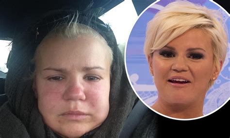 Kerry Katona Left With Swollen Face After Vampire Facelift