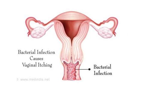 pictures of bacterial infections on vagina how to cure