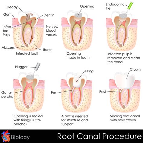 root canal infected tooth stockton ca endodontics