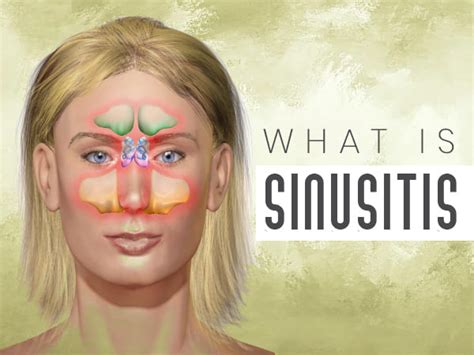 What Is Sinusitis Causes Symptoms Risk Factors