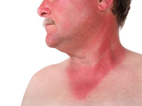 20 Effective Home Remedies For Sunburn Organic Facts