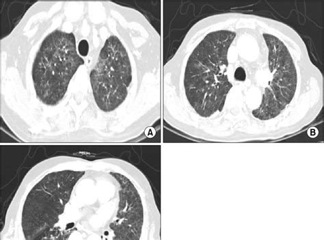 Seven Months Later Follow Up Chest Ct Shows Ground Glass Opacities