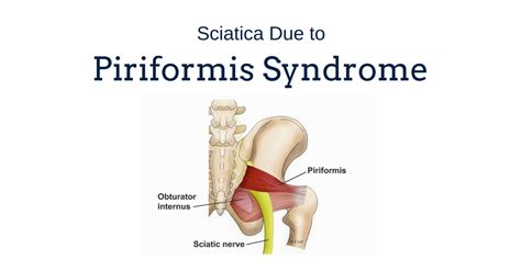 sciatica due  piriformis syndrome gray chiropractic stcatharines