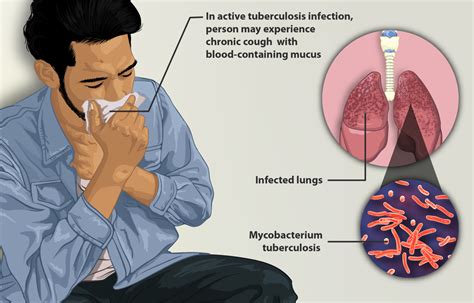 tuberculosis mednotes blog