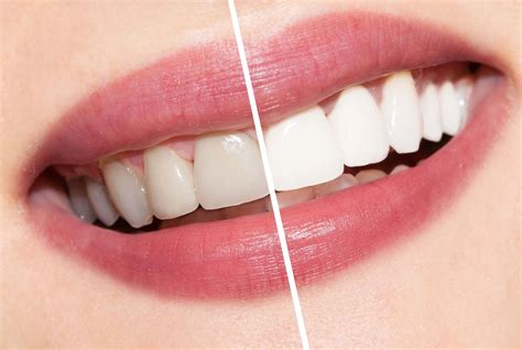 teeth whitening costs  information  dental guide
