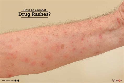 skin rashes caused  drugs