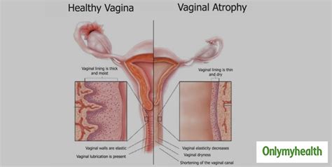 vaginal atrophy know symptoms causes prevention and