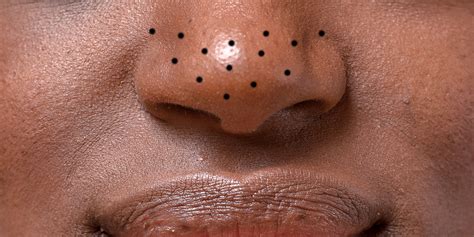 How To Get Rid Of Blackheads On Your Nose Chin And Forehead Self