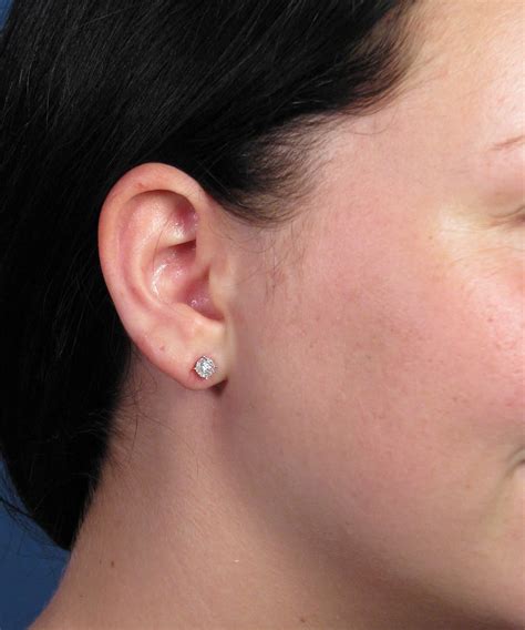 stretched earlobe repair surgery following gauge earring