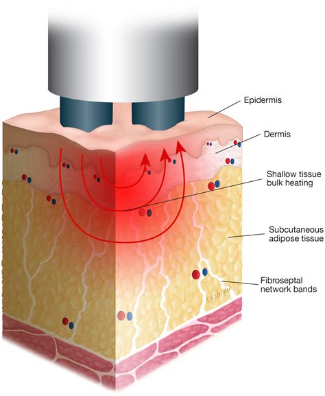 Introduction And Overview Of Radiofrequency Treatments In Aesthetic