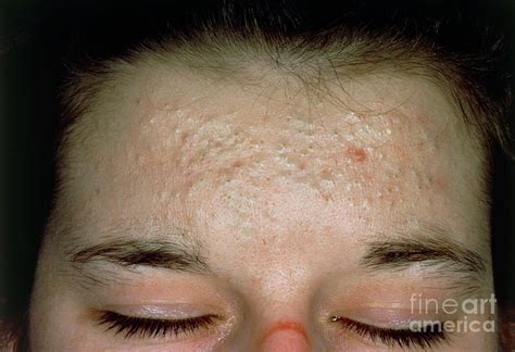 Acne Vulgaris Scarring Over A Woman S Forehead Photograph By St