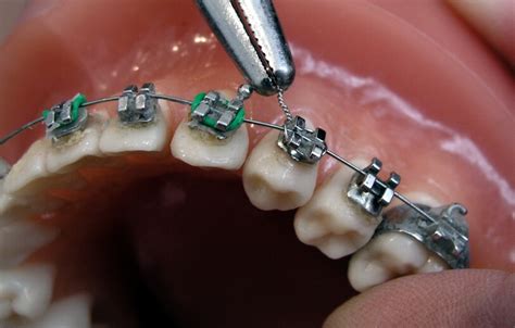 Metal Braces London Orthodontics In London