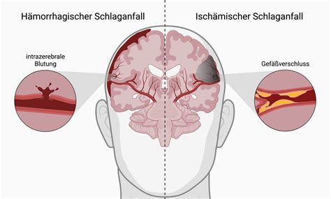 ursachen fuer einen schlaganfall doccheck