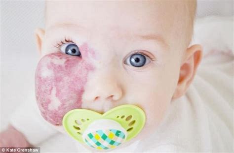 mom of girl with a red birthmark across her face slams strangers who comment daily mail online